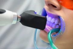 Bleaching Gigi + Scaling Gigi di M&W Family Dental