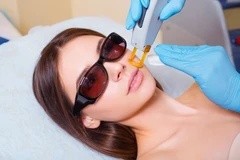 IPL Rejuvenation di La Lune Beauty