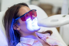 Bleaching Gigi di RRDC Dental Care