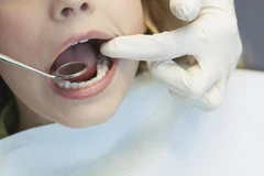 Tambal Gigi GIC per gigi di South Dental