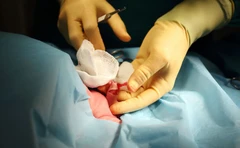 Sunat Dewasa Smart Klamp Premium di Rumah Sunat Jambi