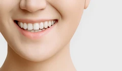 Indirect Veneer Porcelain 8 Gigi di Fre Dental Care