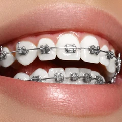 Pasang Behel Metal oleh drg. Umum di Gigiku Family Dental Care