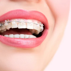 Pasang Behel Keramik oleh drg. Umum di Gigiku Family Dental Care