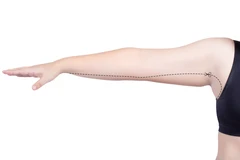 Slimming Bagian Lengan di Infinite Clinics