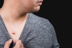 Kill Keloid (L) di Klinik Glowing Anti Aging & Wellness