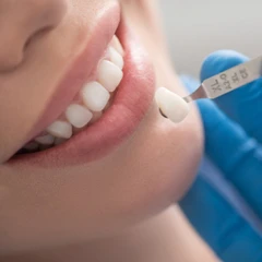 Indirect Veneer Porcelain di Praktik drg. Nina Miranti