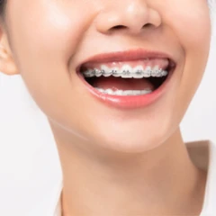 Pasang Behel Metal oleh drg, Spesialis Ortodontik di Praktik drg. Nina Miranti