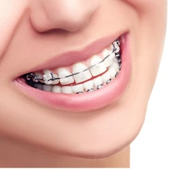 Pasang Behel Keramik oleh drg. Umum di Ruang Dental Clinic