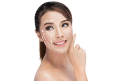 Threadlift Cog Ultimate (4 benang) di Klinik Estetik Ambrosia