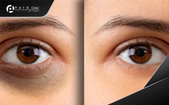 Eyes Dark Circle Laser di Puro Clinic