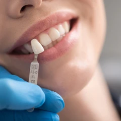 Crown Porcelain Fused to Metal (PFM) di Klinik Gigi Cheer Up