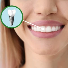 Implan Gigi CDC One Day di Klinik Gigi Cheer Up