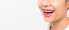 Pasang Behel Metal oleh drg. Umum di Cheerful Dental Clinic