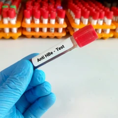 Pemeriksaan Hati (Anti Hbe) di Amalia Medical Center