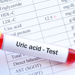 Pemeriksaan Asam Urat di Amalia Medical Center