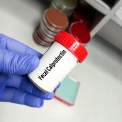 Pemeriksaan Fecal Calprotectin di Amalia Medical Center