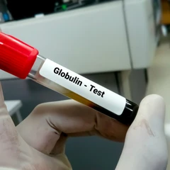 Pemeriksaan Hati (Globulin) di Amalia Medical Center