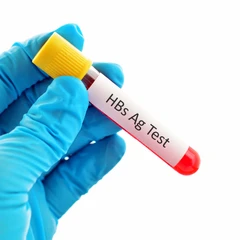 Pemeriksaan Hati (HBs Ag) di Amalia Medical Center