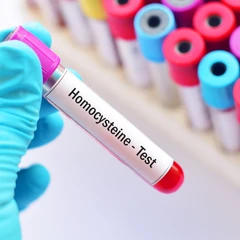 Pemeriksaan Homocystein di Amalia Medical Center
