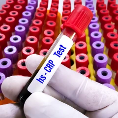 Pemeriksaan Hs CRP di Amalia Medical Center