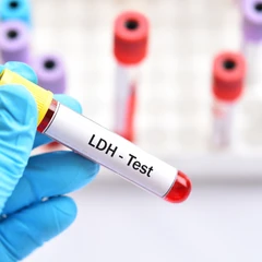 Pemeriksaan LDH di Amalia Medical Center