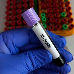 Pemeriksaan NT-Pro BNP di Amalia Medical Center