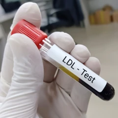 Pemeriksaan Small Dense LDL di Amalia Medical Center