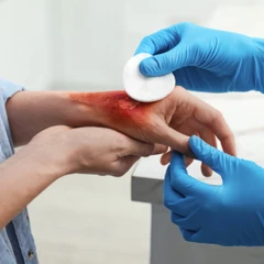 Luka Bakar Derajat Berat di FastMed