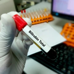 Pemeriksaan Hati (Bilirubin Total) di FastMed