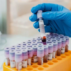 Pemeriksaan Hati (Alkali Fosfatase) di FastMed
