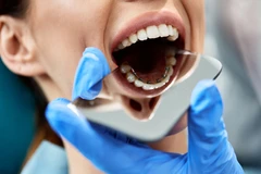 Paket Lepas Bracket di Canina Dental Care
