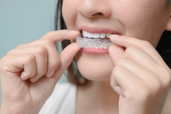 Retainer Lepasan Clear 2 Rahang di JB Dental Clinic