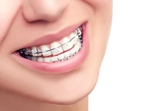 Pasang Behel Metal Comfort Mini oleh drg. Spesialis Ortodontik di JB Dental Clinic