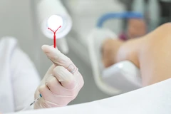 Pemasangan IUD di Klinik Dian
