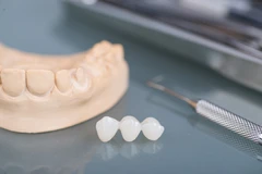 Bridge Porcelain Emax 1 Gigi di Mydentismile