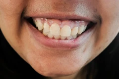 Gingivektomi di Mydentismile