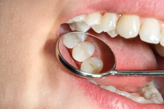 Tambal Fissure Sealant di Ocean Dental
