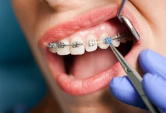 Pasang Behel Metal Pro oleh drg. Umum di Cling Dental Clinic