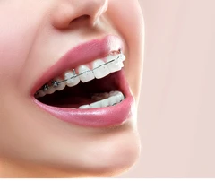 Pasang Behel Sapphire Metal oleh drg. Umum di Cling Dental Clinic