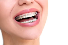 Pasang Behel Metal Damon oleh drg. Umum di Cling Dental Clinic