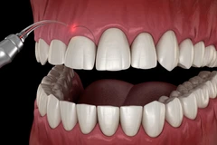 Gingivektomi Ringan di Cling Dental Clinic