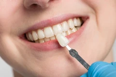 Lepas Veneer Sulit di Cling Dental Clinic