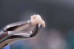 Pencabutan Penyulit Kecil di Cling Dental Clinic