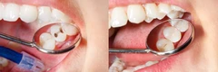 Tambal Gigi Kelas 1 di Estetika Dental Clinic
