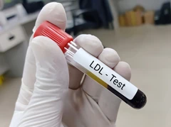 Pemeriksaan LDL di Klinik Ammyn Sukabumi