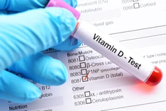 Pemeriksaan Vitamin D di Biotest Laboratorium