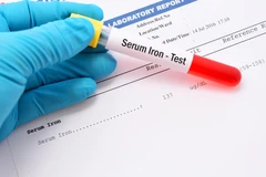 Pemeriksaan Kadar Zat Besi di Beta Health Care