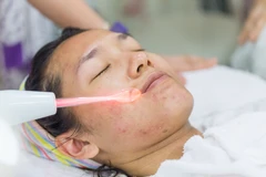 IPL Upper Lip di Nadisa Beauty Care