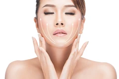 Derma Melasma/Flek di Nadisa Beauty Care